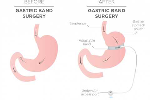 How It Works, Surgery, Who Should Have It