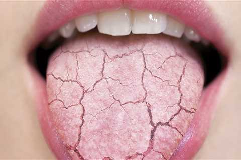 Natural Treatment For Dry Mouth - SuperFoodish.com