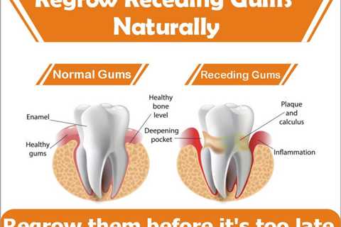 Can Receding Gums Be Reversed Naturally? – Health Sports Center