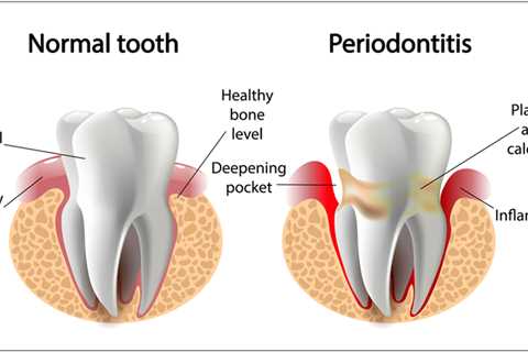Best Natural Toothpaste For Periodontal Disease — Dr. Rehna Trydil — Medium
