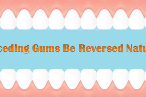 Reverse Receding Gums Naturally At Home - Dental Health and Beauty