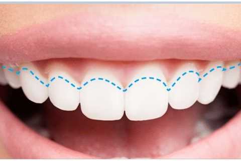 Can Receding Gums Grow Back Without Surgery? - Get Healthy Project