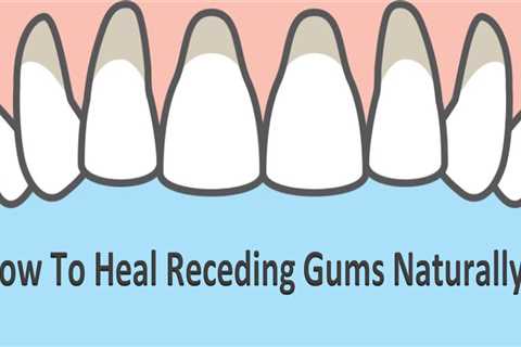 How To Heal Receding Gums Without Surgery? - Vitamins Health