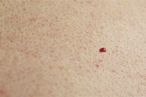 What Are Those 'Red Moles' On Your Skin?