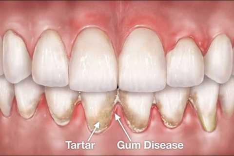 Natural Remedy for Receding Gums - Dentists Atlanta