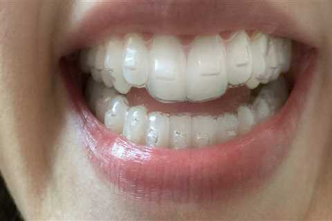 What are the disadvantages of invisalign?