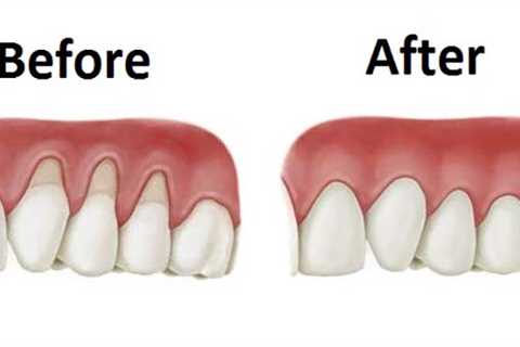 Repair Receding Gums Naturally - Ideal Health Fitness