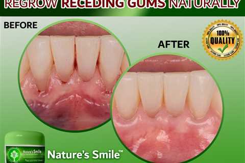 Natures Smile Side Effects