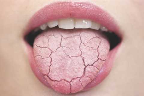 What foods help with dry mouth