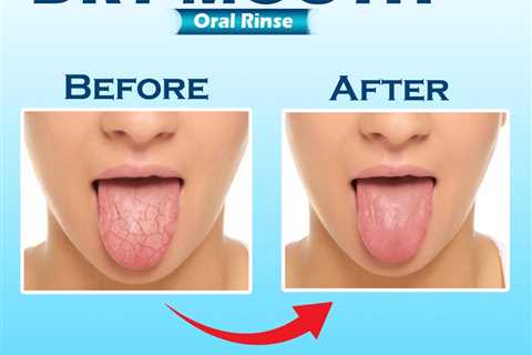 What Can I Do for Dry Mouth