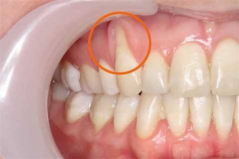 Regrowing Receding Gums