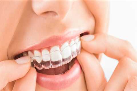 Invisalign which teeth move first?