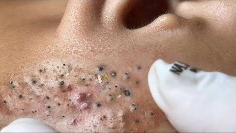Big Cystic Acne Blackheads Extraction Blackheads, Whiteheads Removal Pimple Popping VS