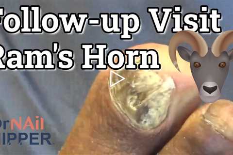 Follow-up Visit of Best Ram's Horn ALL YEAR.  How to care for thick toenails? FEET-ure Friday (2022)