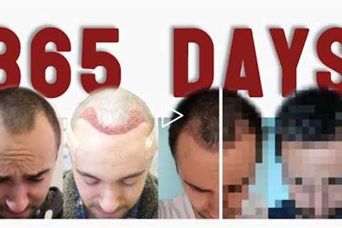 DAY 1 to DAY 365: a Picture a Day after a Hair Transplant [TIME-LAPSE]