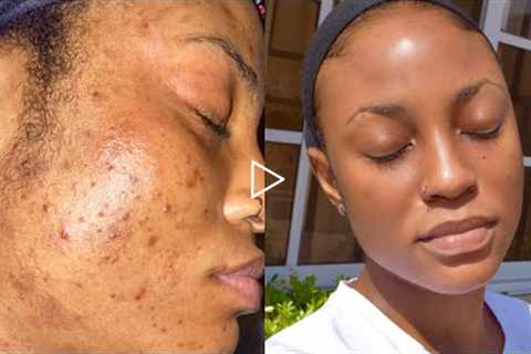 SKINCARE ROUTINE FOR OILY ACNE PRONE SENSITIVE SKIN || How I deal with Hyper Pigmentation &..