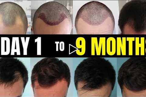 Evolution of Transplanted Hair, from Day 1 to 9 Months