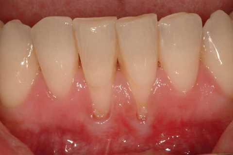 Heal Receding Gums Without Surgery