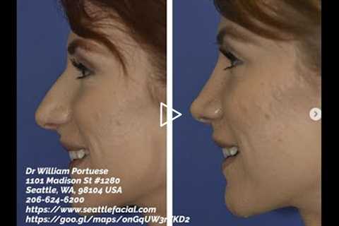 Nose Job Seattle WA | Best Rhinoplasty Surgeon in Seattle