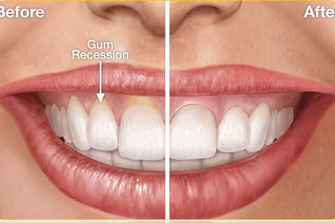 Gum Regrowth
