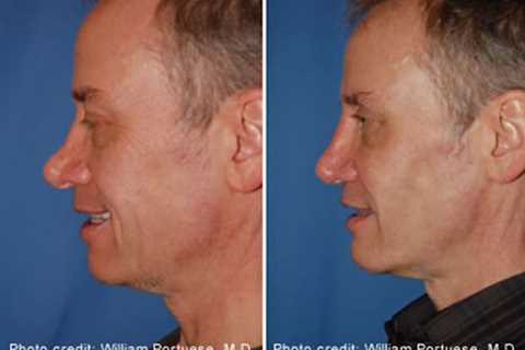 The Portland Center for Facial Plastic Surgery : Rhinoplasty, Facelift Surgery