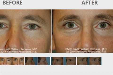 The Seattle Eyelid & Blepharoplasty Center