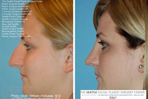 facelift seattle | Nose surgery, Botox, Facelift