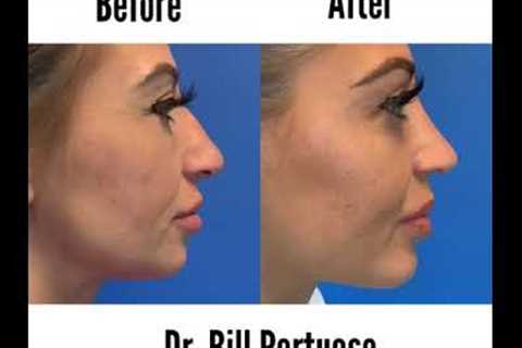 Nose Job Before and After Transformation