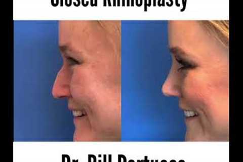 Getting a Rhinoplasty -  Is Nose Surgery Right For Me