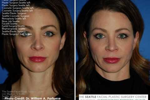 Pin on facial feminization surgery washington state