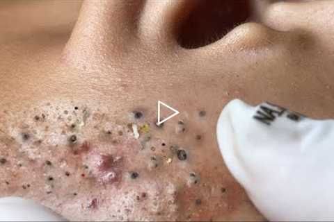 Big Cystic Acne Blackheads Extraction Blackheads, Whiteheads Removal Pimple Popping VS