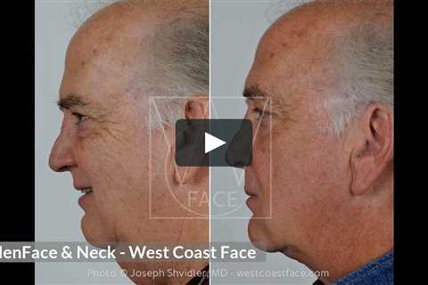 Facial Plastic Surgery For Men in Seattle WA