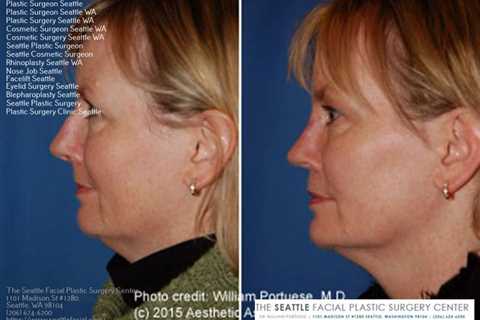 best rhinoplasty surgeon near me | Rhinoplasty surgeon, Rhinoplasty, Facial plastic