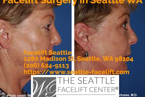 Facelift Seattle