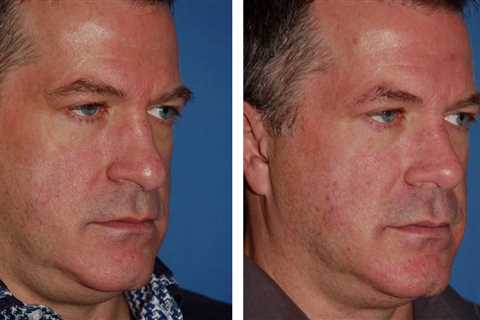 Revision Rhinoplasty Seattle - Rhinoplasty Redo