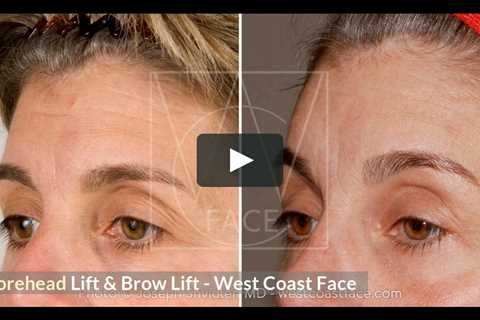 Forehead Lift & Brow Lift in Seattle Washington