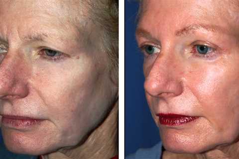 Browlift Surgery in Seattle Washington - Dr William Portuese