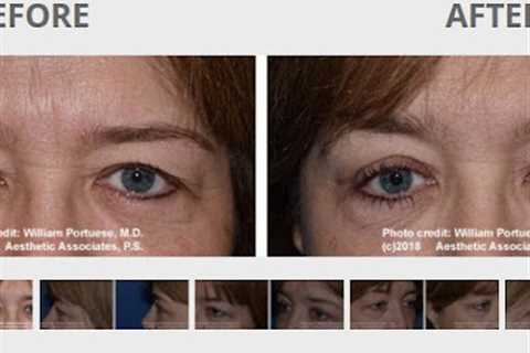 Eyelid Surgery in Portland Oregon 