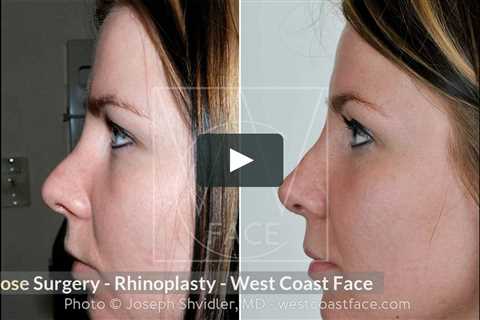 Nose Surgery in Seattle Washington