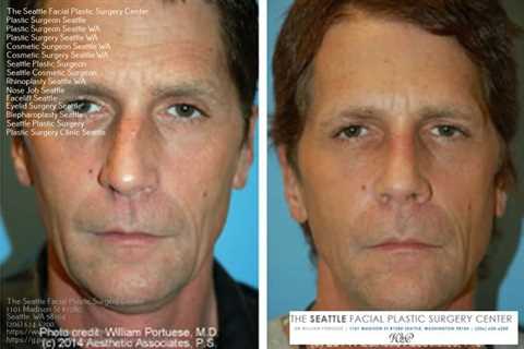 plastic surgery seattle | Rhinoplasty, Botox, Plastic surgery