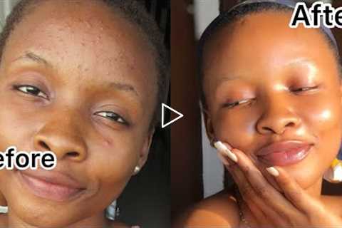 How I Truly Got Rid Of My Pimples In 2 Weeks | Clear Skin |