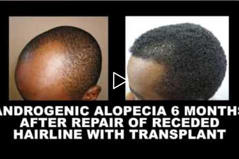 Hair Growth Time-frame After Hair Transplant