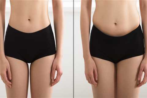 Is laser liposuction?