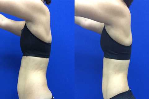 How soon after laser lipo can you see results?