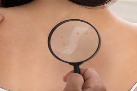 Is skin cancer itchy?