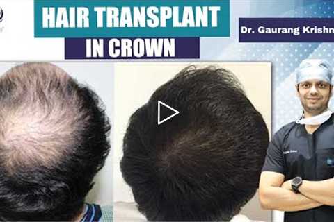 👨🏻👴🏻Hair Transplant in Crown Area ✅ | Best Crown Area Hair Transplant Result in India | MedLinks