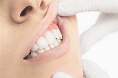 Home Remedies For Bad Receding Gums