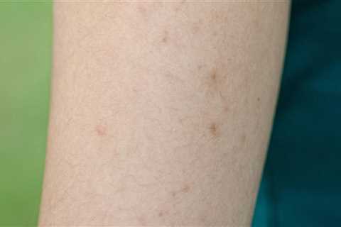 Will laser hair removal help keratosis pilaris?