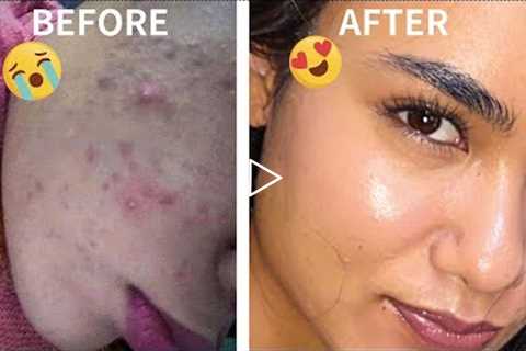how i got rid of my ACNE on BUDGET| minimal skin care routine