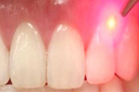 Does laser treatment damage teeth?